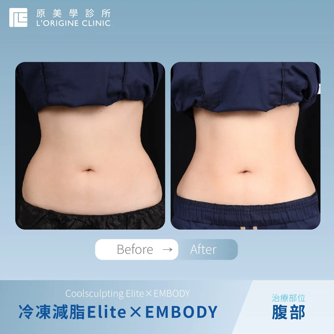 冷凍減脂 × EMBODY 腹部 療程前後