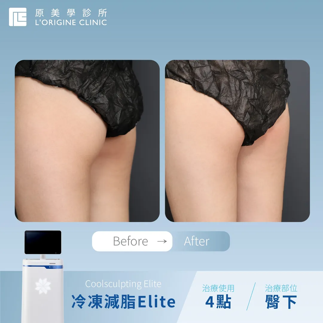 臀下・4 點