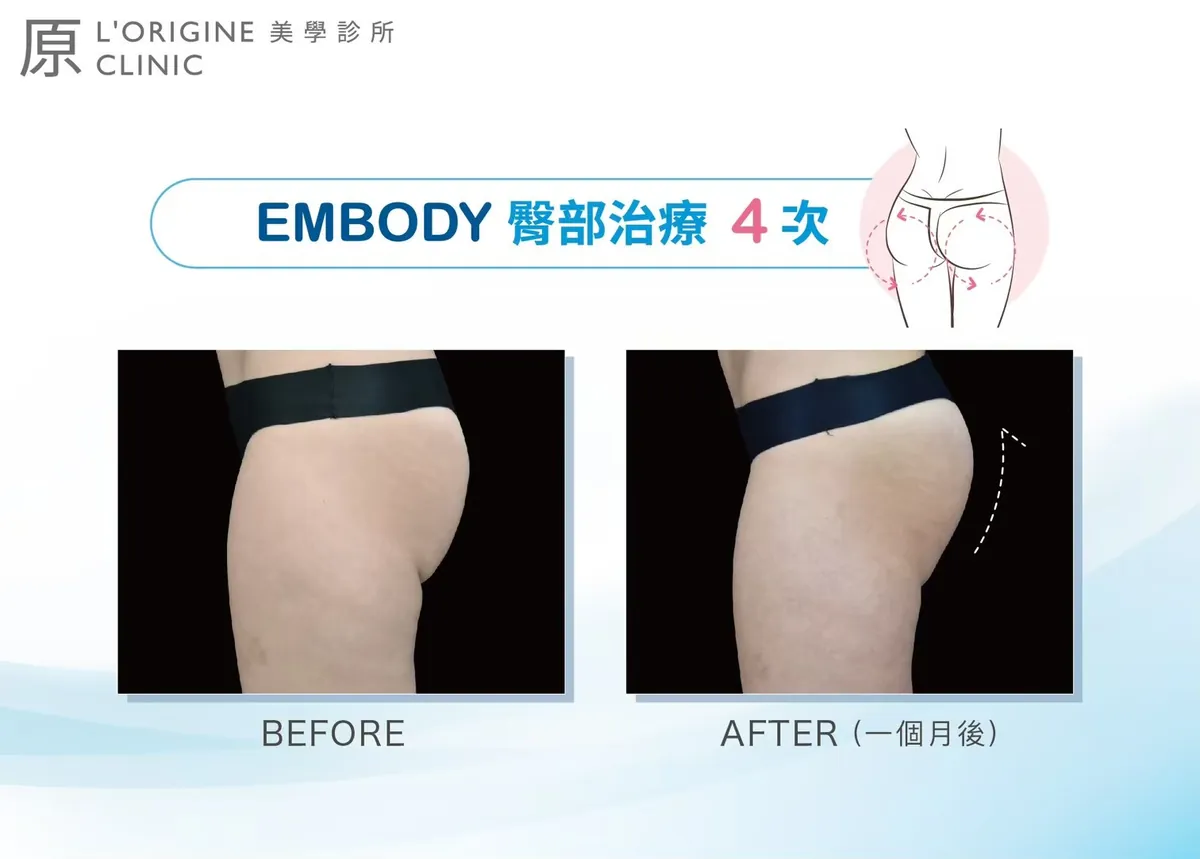 EMBODY 療程前後