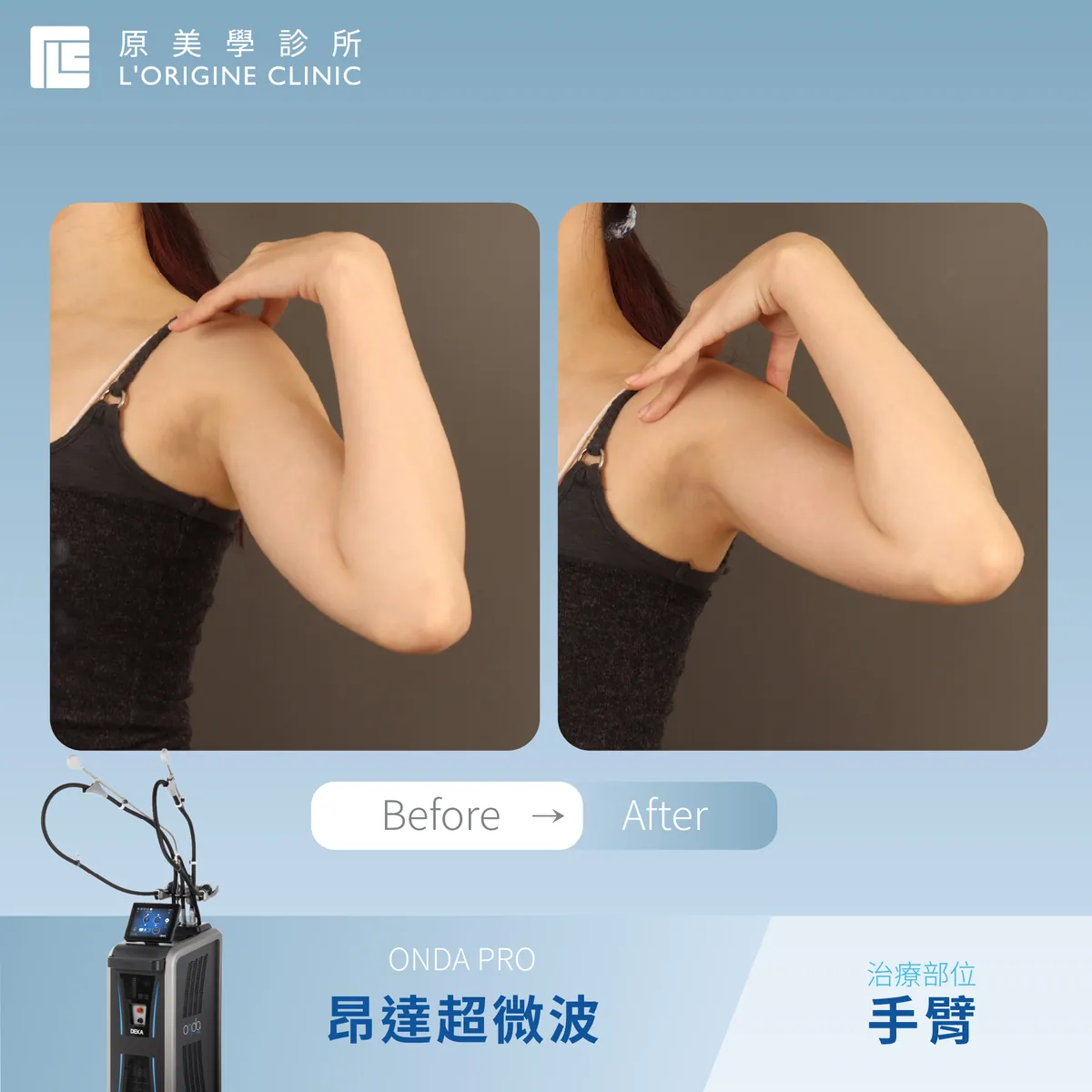 ONDA PRO 手臂 療程前後