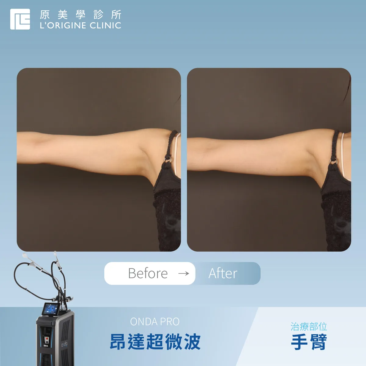 ONDA PRO 手臂 療程前後