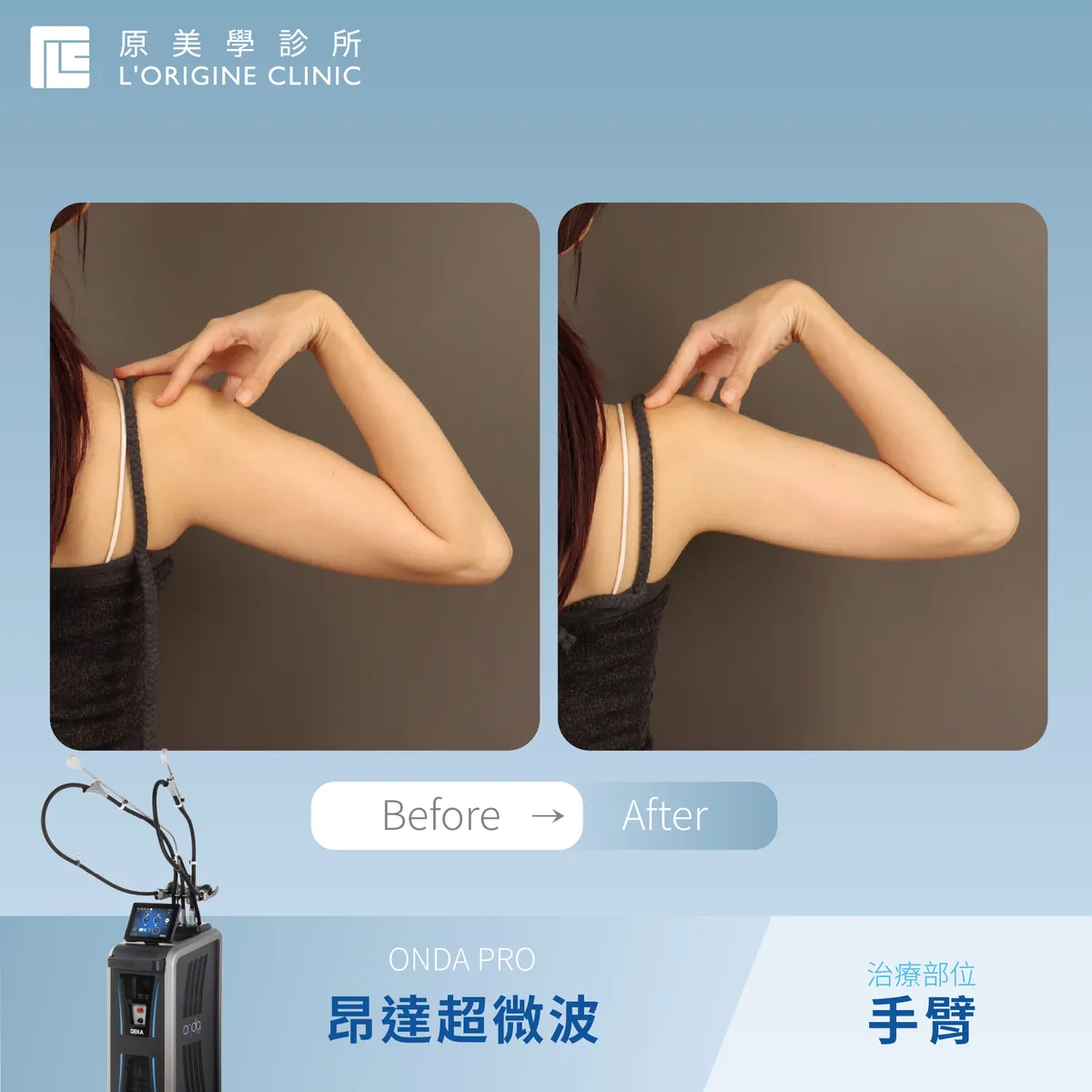 ONDA PRO 手臂 療程前後