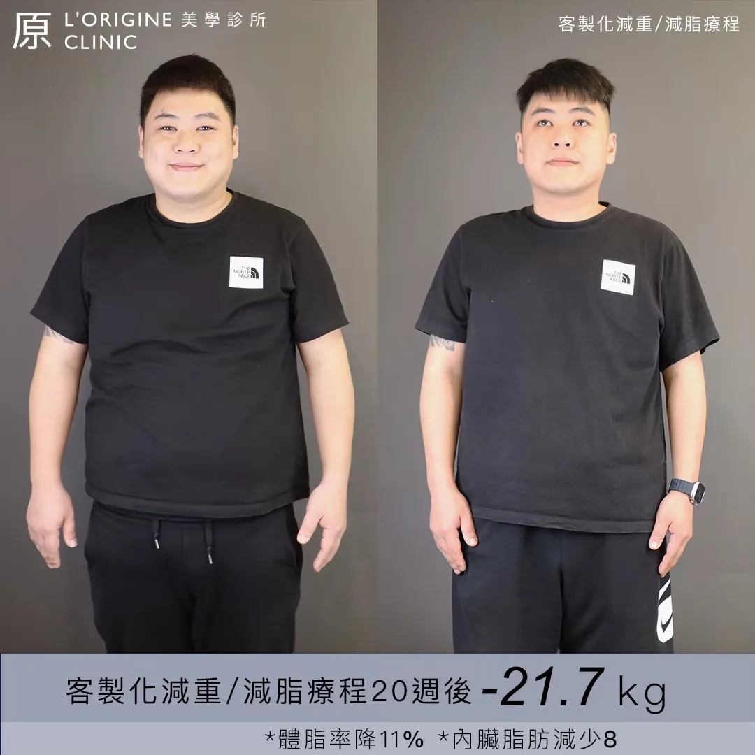 醫師減重門診 療程前後