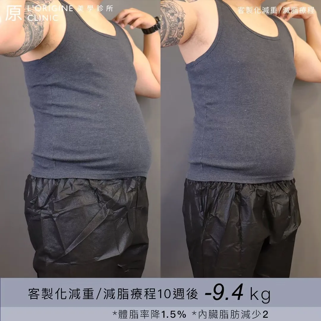 醫師減重門診 療程前後
