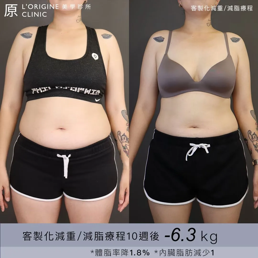 醫師減重門診 療程前後