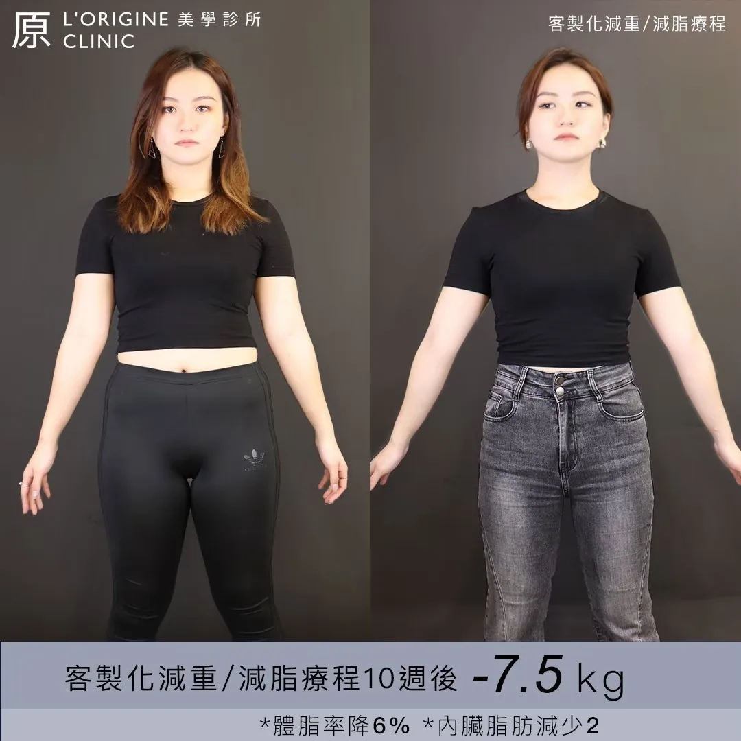 醫師減重門診 療程前後