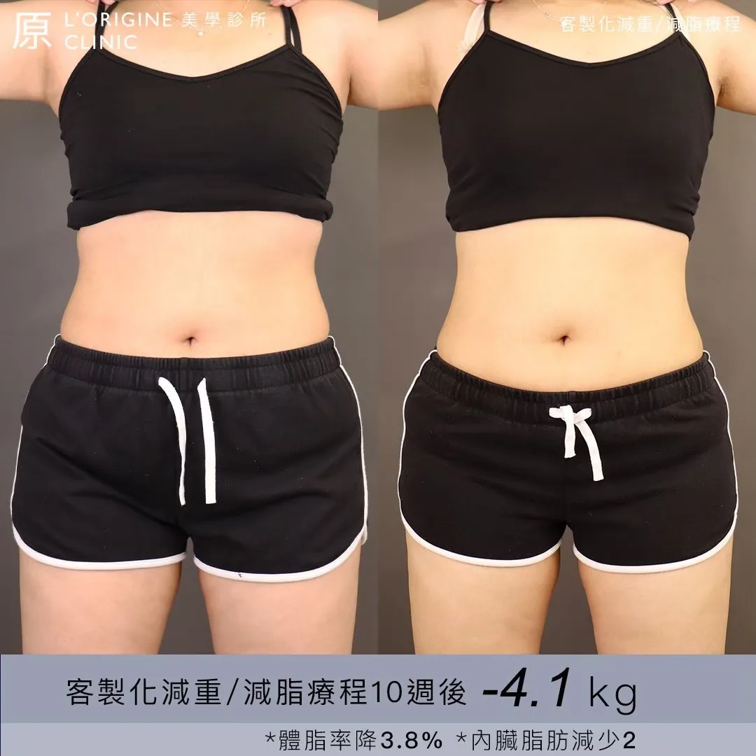 醫師減重門診 療程前後