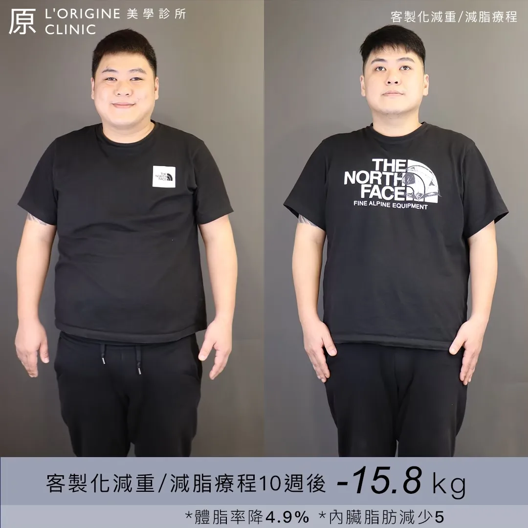 男性 醫師減重門診 療程前後