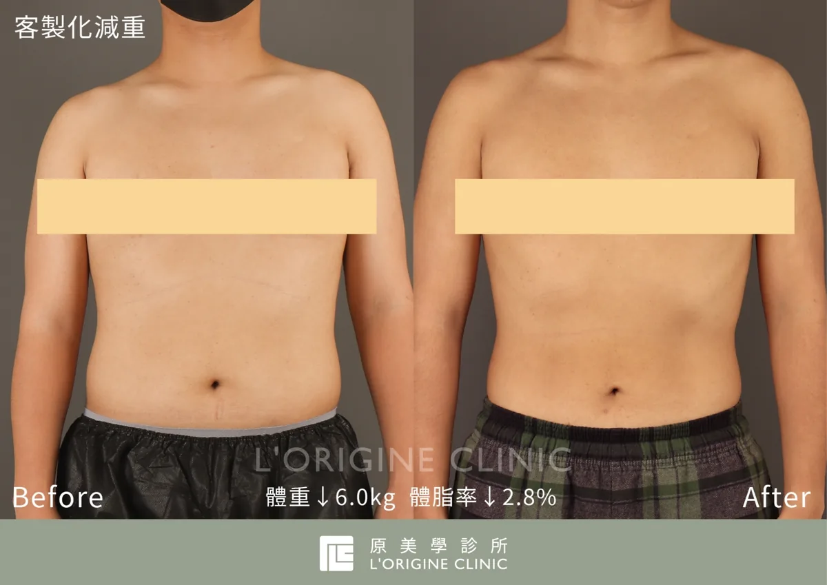 男性 醫師減重門診 療程前後